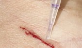 wound
